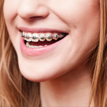 Understanding the Parts of Traditional Braces and Their Purposes in Coral Springs, FL